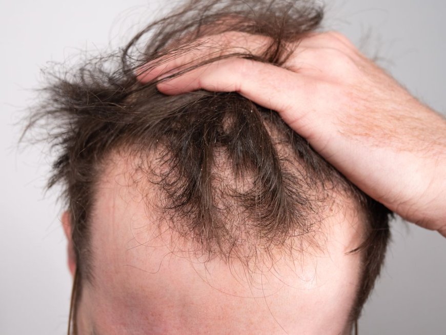 This Sugar Could Be A Cure For Male Pattern Baldness – And It’s Been In Our Bodies All Along