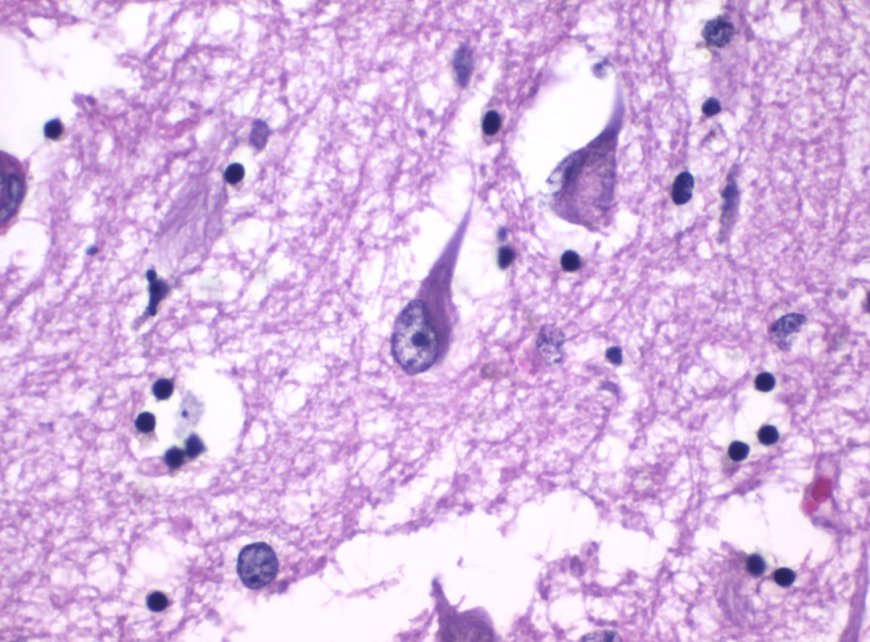 Alzheimer’s-Linked Protein Levels “20 Times Higher” In Newborn Babies – What Does This Mean?