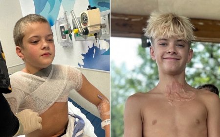 Microwaved squishy toy explodes onto boy's face and chest amid viral trend, causing horrific burns