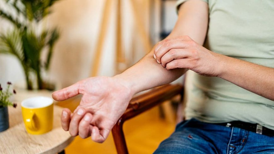 Why scratching a mosquito bite makes it so much worse, according to science