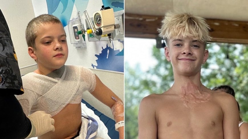 Microwaved squishy toy explodes onto boy's face and chest amid viral trend, causing horrific burns