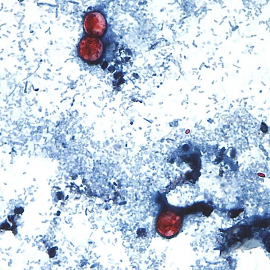 Cases of cyclosporiasis deserve attention but shouldn’t alarm, says Quebec doctor