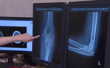 Doctors warn of ‘exponential’ rise in serious e-scooter injuries among kids
