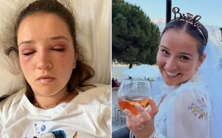 Bride cautions others before wedding day about risky beauty treatments: 'Pain wasn't worth it'