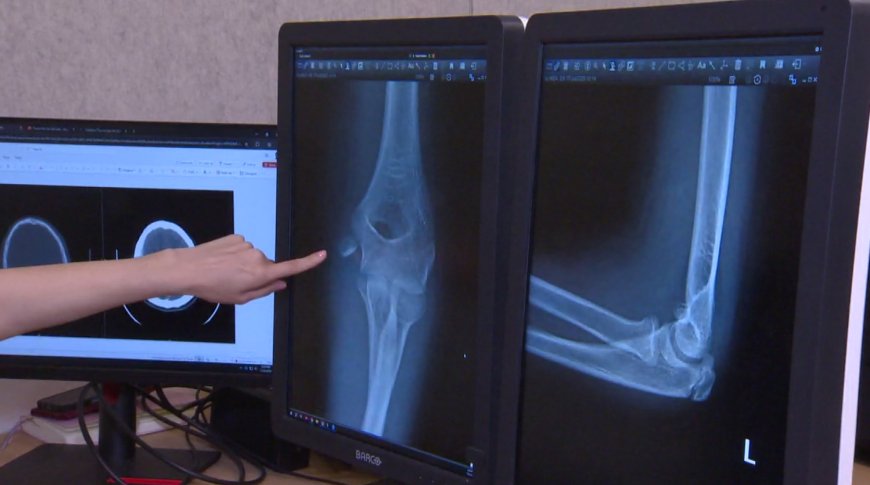 Doctors warn of ‘exponential’ rise in serious e-scooter injuries among kids