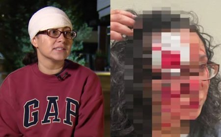 Shock: Woman Sustains ‘Zombie Bite’ To Face In Wild Random Downtown Attack