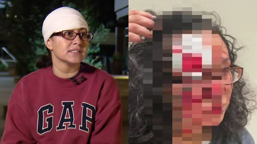 Shock: Woman Sustains ‘Zombie Bite’ To Face In Wild Random Downtown Attack